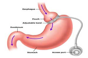 Top Hospitals For Affordable Cost Laparoscopic Bariatric Surgery In India